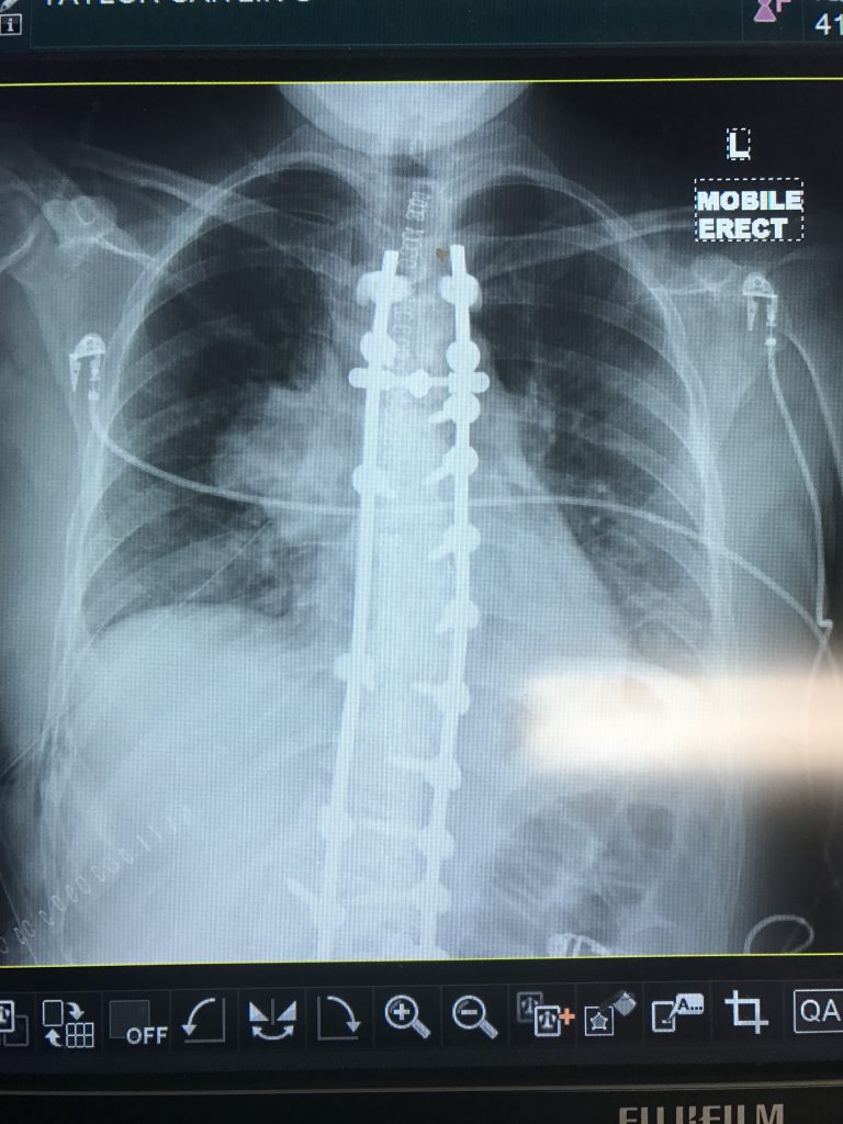 Scoliosis X ray showing a thymoma present